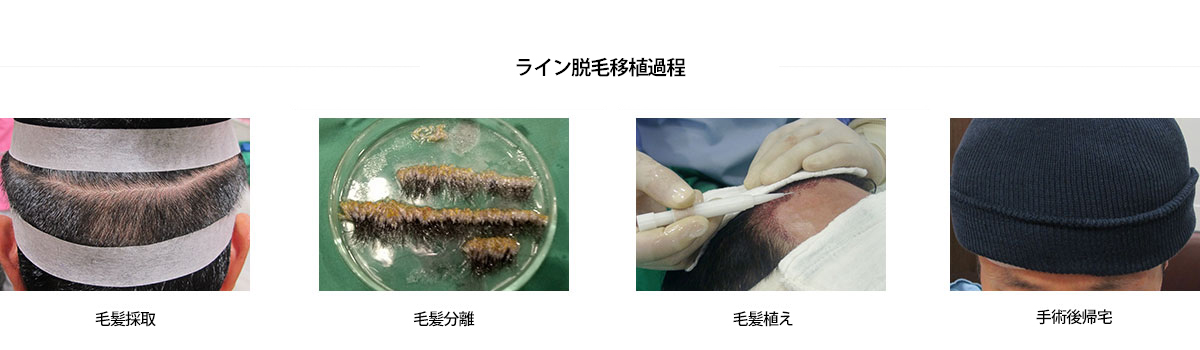 ライン皮膚科脱毛移植過程