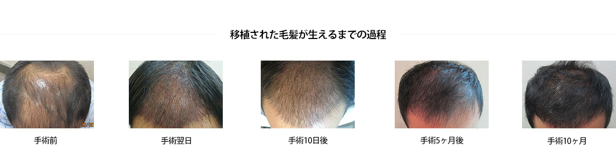 移植された毛髪が生えるまでの過程